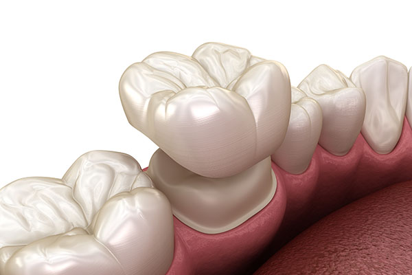 dental crowns near you