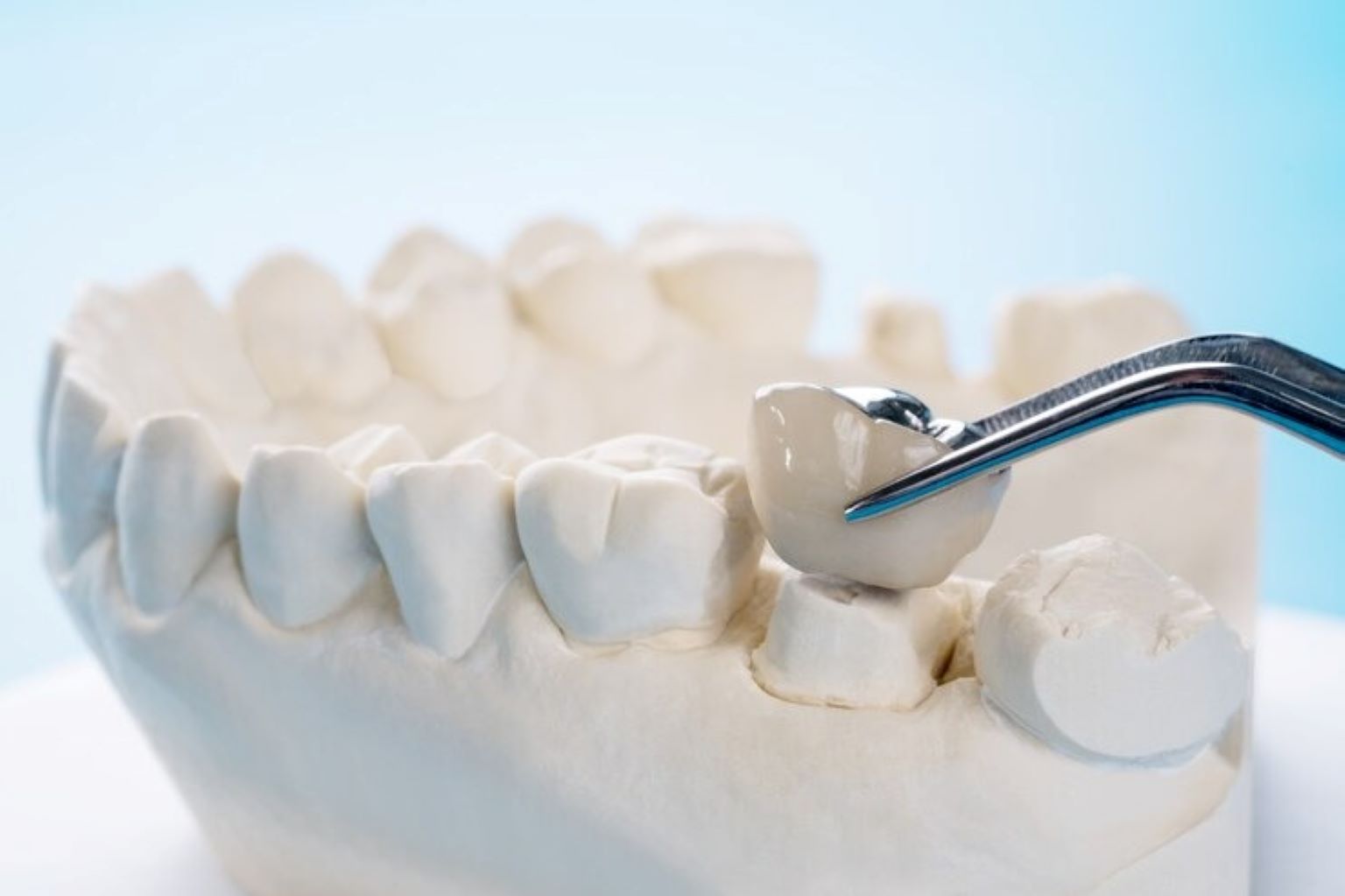 How to Maintain Your Dental Bridge for Years of Healthy Smiles