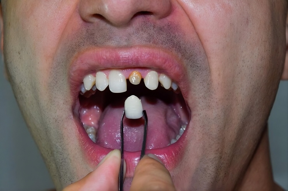 Can a Dental Crown Repair a Cracked Tooth?